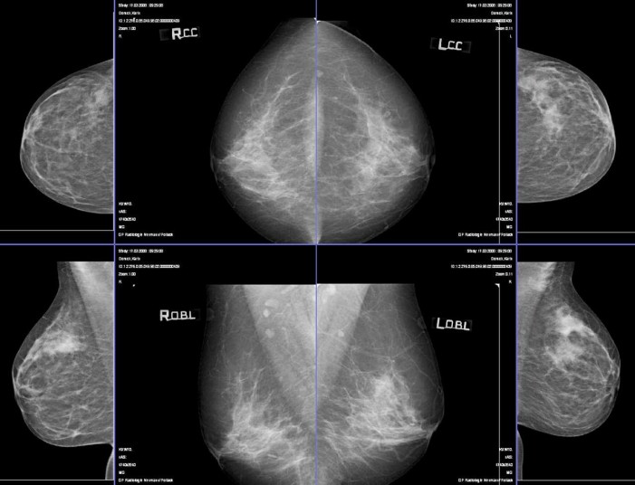 U Domu zdravlja Inđija pušten u rad mamograf
